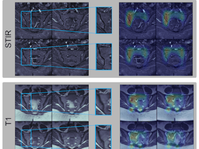 Deep Learning for Automated Detection of Sacroiliitis on Biparametric&nbsp;MRI