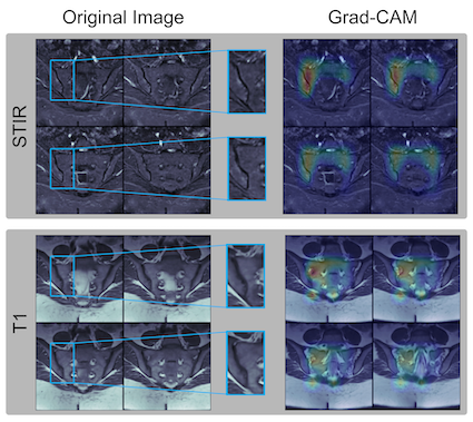 Deep Learning for Automated Detection of Sacroiliitis on Biparametric MRI